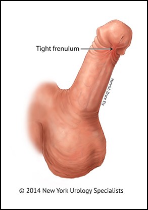 Urologist frenuloplasty procedure Edmonton