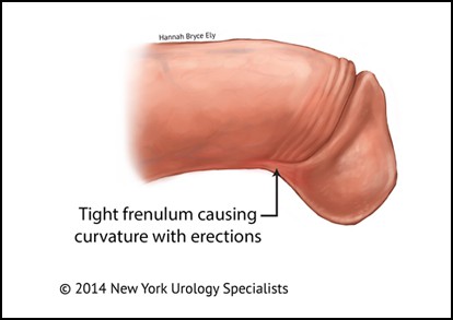 Frenulum breve urologist