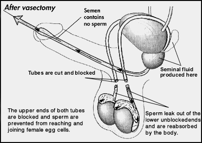 Brisbane urology vasectomy