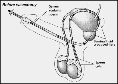 Laser vasectomy Brisbane